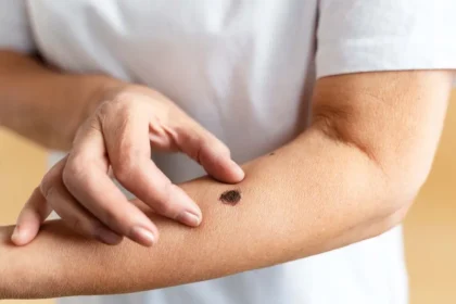 Aumentan los casos de cáncer de piel en el país: especialistas alertan sobre diagnóstico tardío
