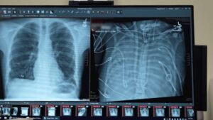 Tecnología de respiración artificial mantiene vivo a un paciente en espera de trasplante