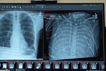Tecnología de respiración artificial mantiene vivo a un paciente en espera de trasplante
