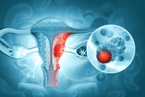 Inflamación abdominal y dolor pélvico: señales de alerta del cáncer de ovario