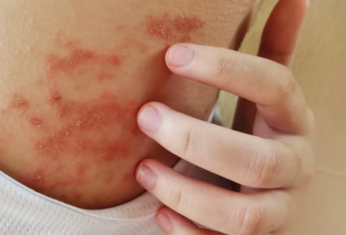 Dermatitis por calor: cómo identificar y prevenir el sarpullido más común del verano