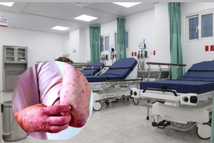 SNS asegura que hospitales están preparados ante casos de viruela símica