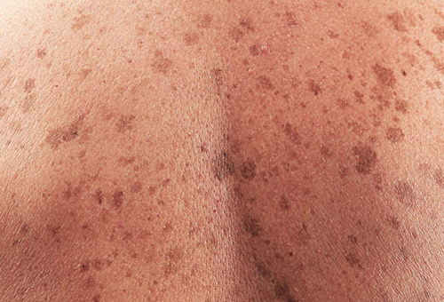 Cuba desarrolló candidato terapéutico contra el melanoma y se prepara para probarlo en humanos