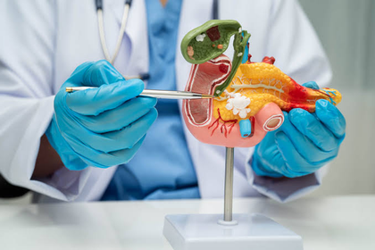 Nuevo tratamiento oral ofrece una alternativa para pacientes con cáncer de páncreas metastásico