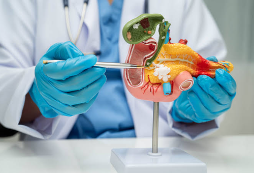 Nuevo tratamiento oral ofrece una alternativa para pacientes con cáncer de páncreas metastásico